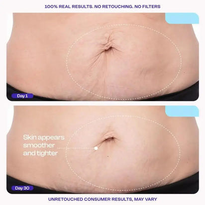 Belly Firming Cream – Lifts, Firms & Smooths Sagging Skin | Postpartum & Anti-Aging Abdominal Treatment Klyra