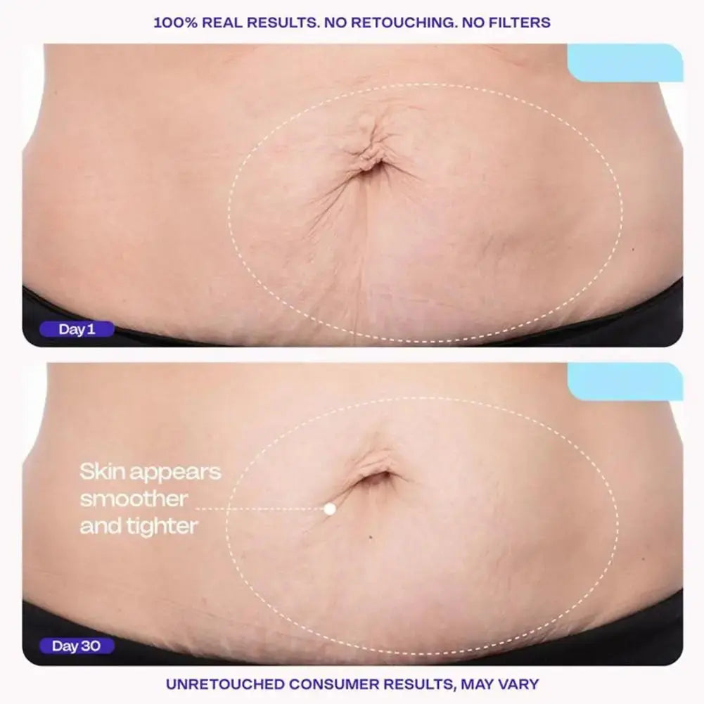 Belly Firming Cream – Lifts, Firms & Smooths Sagging Skin | Postpartum & Anti-Aging Abdominal Treatment Klyra